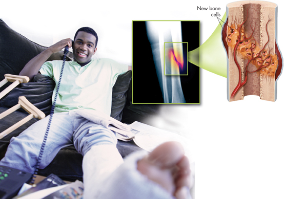 A photograph shows a person with plaster in one leg. The illustration shows healing with new bone cells.