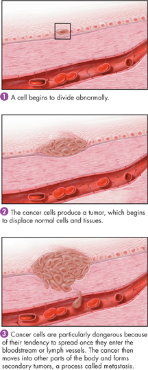 An illustration shows growth of cancer cell.