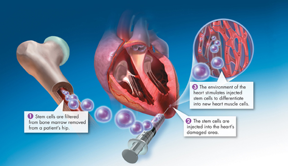 An illustration shows a possible treatment for heart disease in the future.
