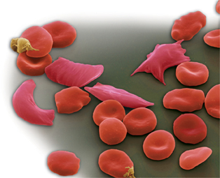 Sickle and normal blood cells.