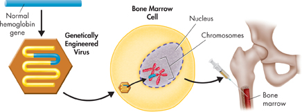 An illustration on how gene therapy can be carried out. A normal hemoglobin gene is placed in a virus. This genetically engineered virus is inserted into the patient’s bone marrow cell, so that the virus inserts the healthy gene into the affected cell.