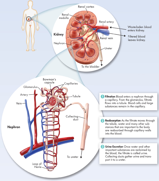 A pictorial depiction of the urinary system in human body on the top left. An enlarged picture of the kidney on the right. An enlarged picture of nephron at the bottom.