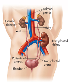 A pictorial depiction of the urinary system along with a transplanted kidney in the human body.