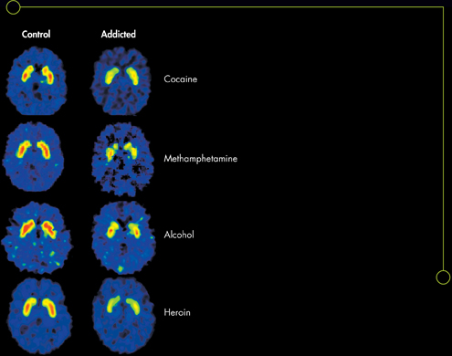 Positron emission tomography images of normal brain on the left and those addicted to cocaine, methamphetamine, alcohol and heroin on the right one below the other.