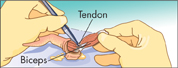 An illustration showing tendon being pulled off the biceps using forceps.