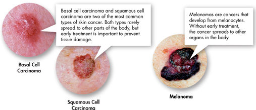 Photographs of basal cell carcinoma, squamous cell carcinoma and melanoma.