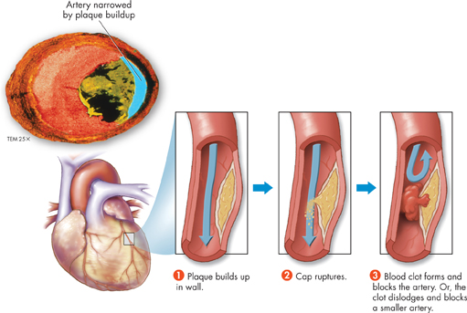 An illustration of atherosclerosis.