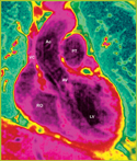 Magnetic Resonance Imaging of the heart.