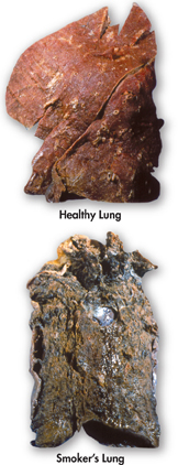 Images of a healthy lung and a smoker’s lung.