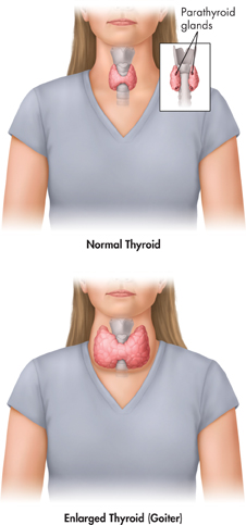 A picture indicating normal thyroid gland in the human body. On the right, a picture indicating the parathyroid glands inside a text box. Below it, a picture indicating an enlarged thyroid gland (goiter) in the human body.