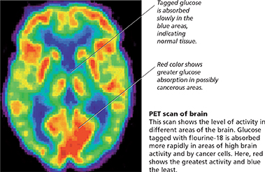 A Positron Emission
Tomography scan of the brain