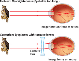 A diagram of a nearsighted eye showing how it can be corrected with the appropriate lens.
