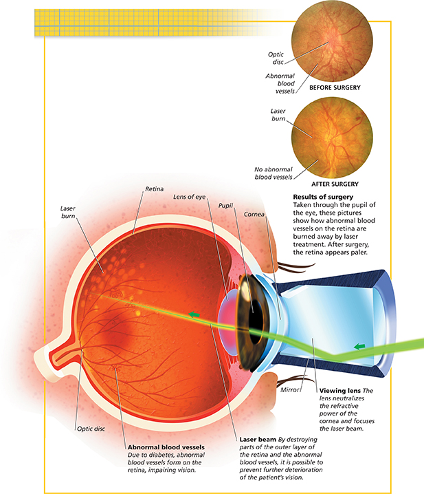 A diagram showing how laser surgery works to correct vision problems.