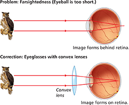 A diagram of a farsighted eye and how it can be corrected with the appropriate lens.